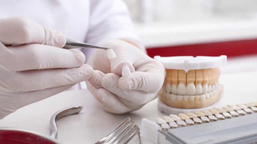 Veneers